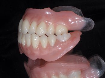 Full upper and Lower dentures (1)