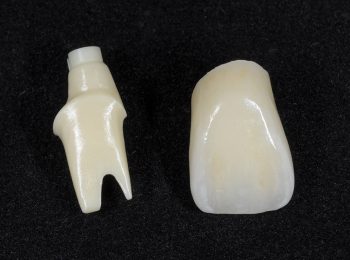 Implant crown and Abutment (1)