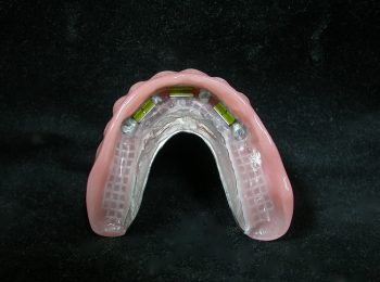 Implant over denture (1)