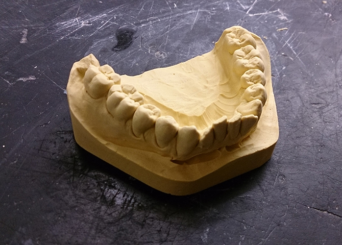 Plaster Cast Dental Models vs 3D Digital Models