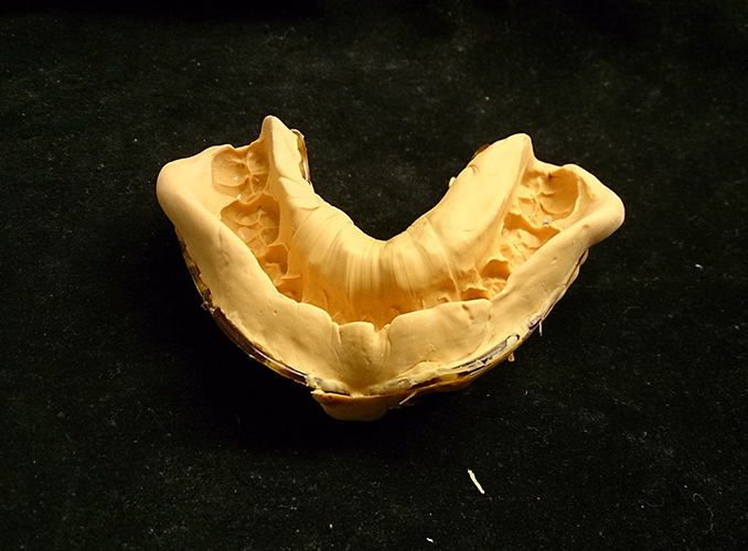 Plaster Cast Dental Models vs 3D Digital Models